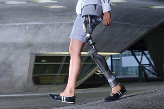 Hip joint prosthesis with iglide® bearings by Otto Bock HealthCare GmbH